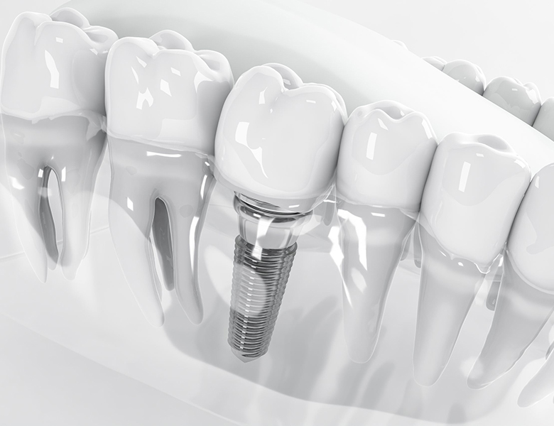 秋葉原・御徒町・浅草橋の歯医者、中島歯科クリニックの歯科用CTによる精密診断