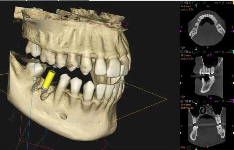 秋葉原・御徒町・浅草橋の歯医者、中島歯科クリニックの歯科用CTによる精密診断